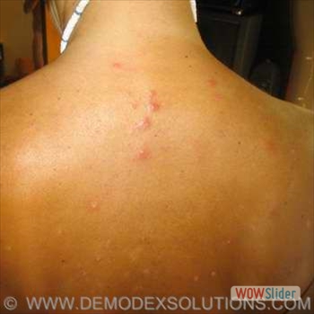 Acne_back
