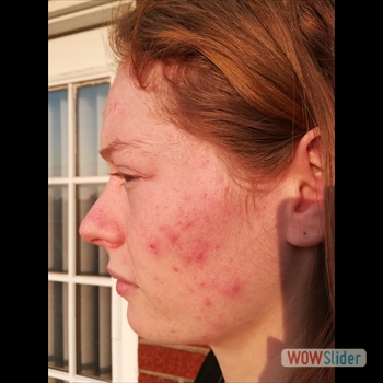 Acne_cheek