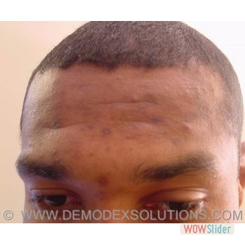 Acne_forhead