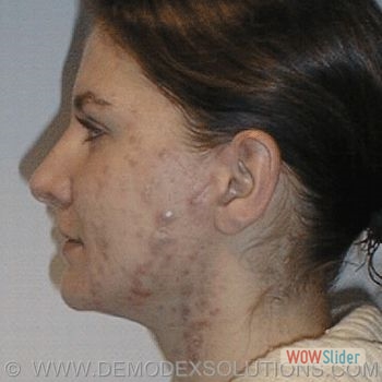 cystic acne