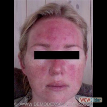 Rosacea
