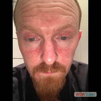 Rosacea-2