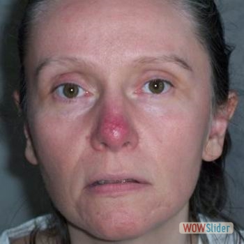 Rosacea_nose