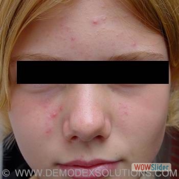 Teenager_acne